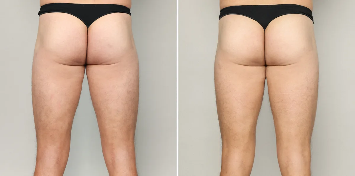 HYAcorp (augmentation fessière) : résultat avant et après, cas 2