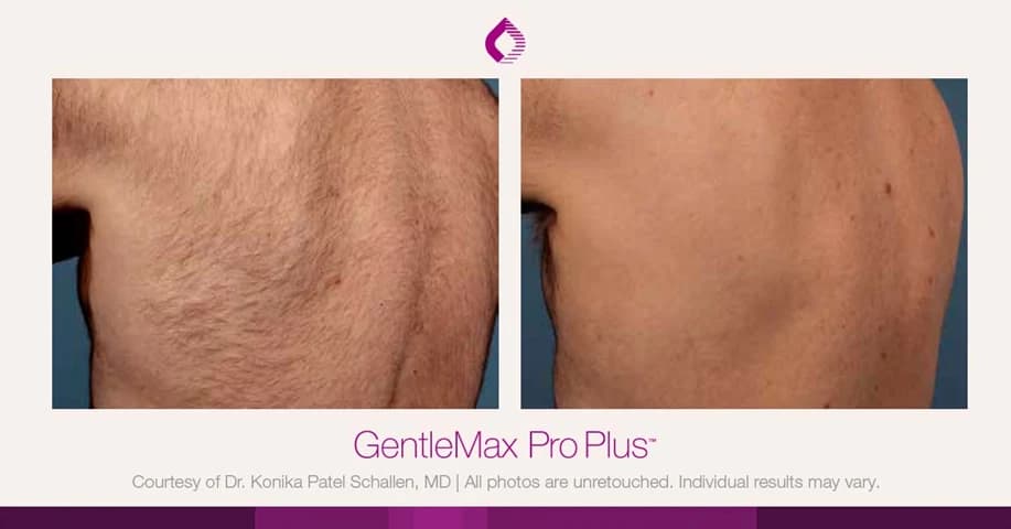 Candela GentleMax Pro Plus® : résultat avant et après, cas 1