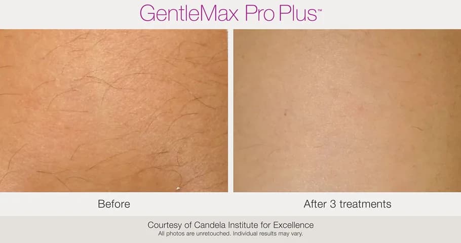 Candela GentleMax Pro Plus® : résultat avant et après, cas 4
