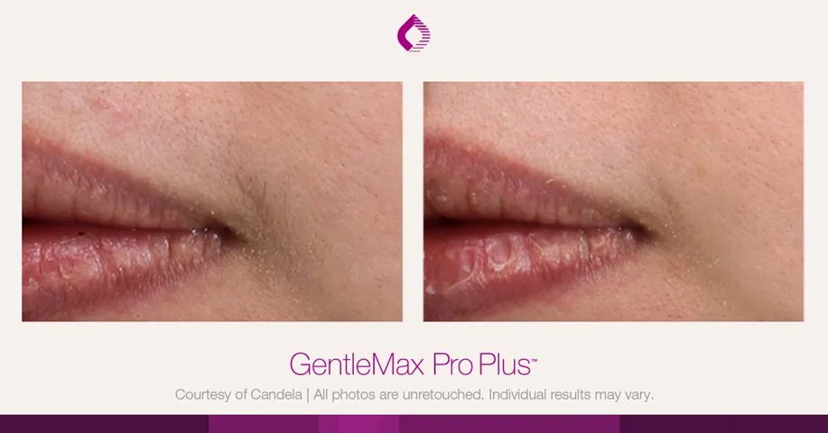 Candela GentleMax Pro Plus® : résultat avant et après, cas 6