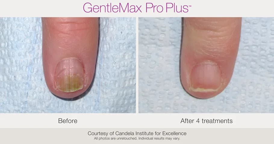 Candela GentleMax Pro Plus® : résultat avant et après, cas 8