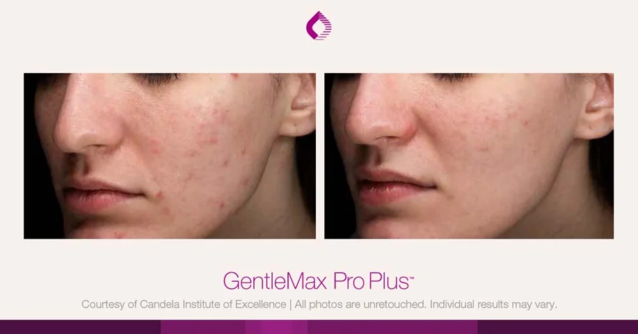 Candela GentleMax Pro Plus® : résultat avant et après, cas 9