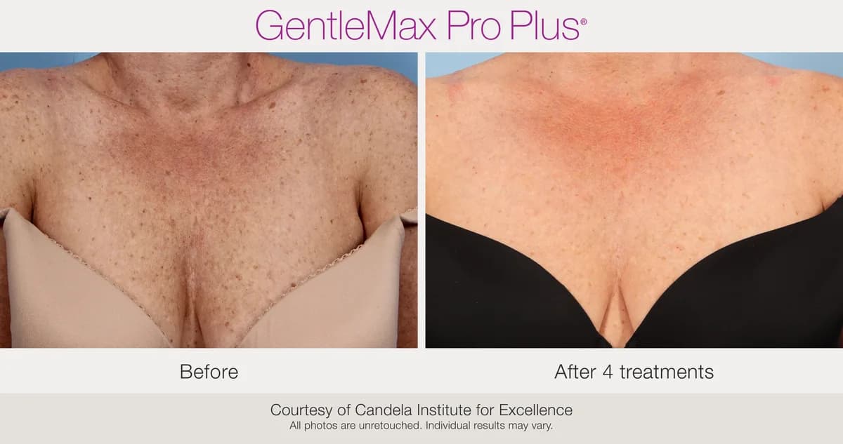 Candela GentleMax Pro Plus® : résultat avant et après, cas 10