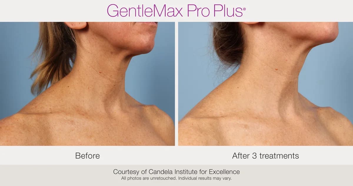 Candela GentleMax Pro Plus® : résultat avant et après, cas 11