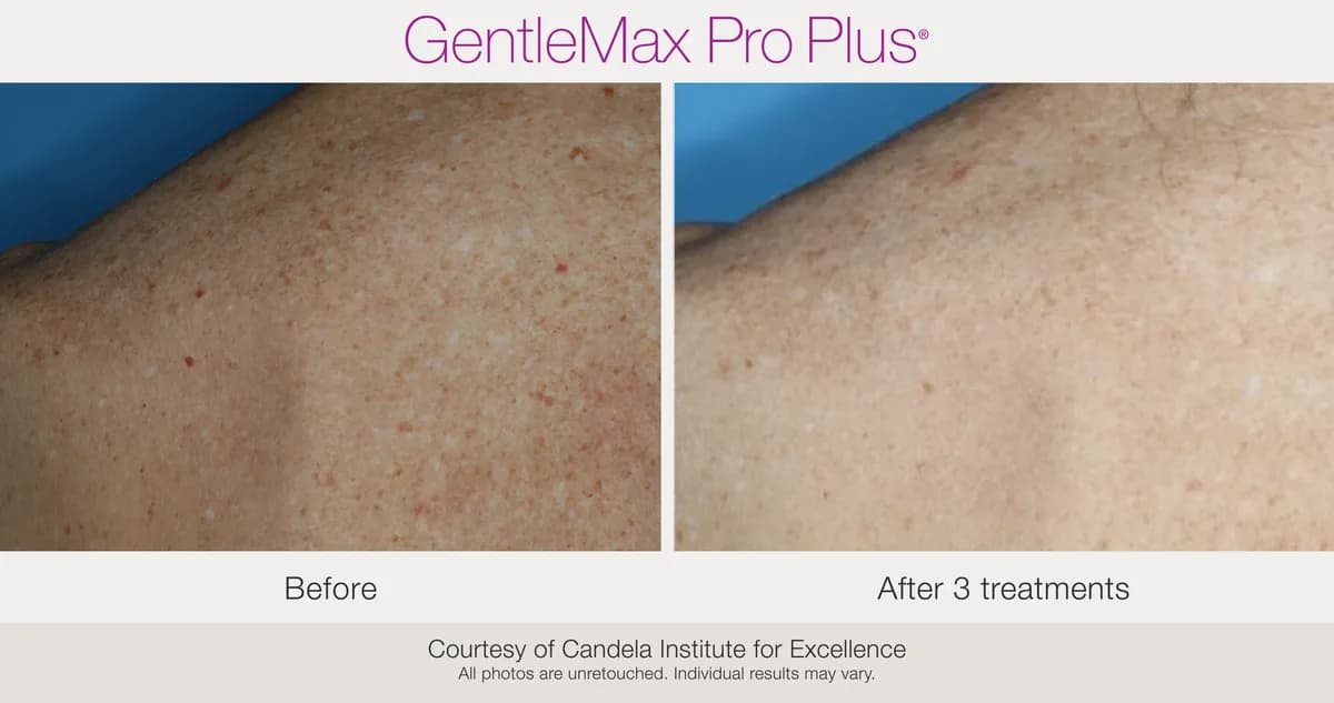 Candela GentleMax Pro Plus® : résultat avant et après, cas 12