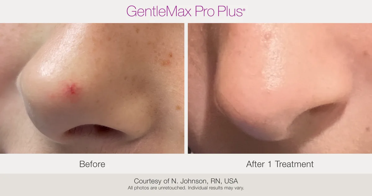 Candela GentleMax Pro Plus® : résultat avant et après, cas 13