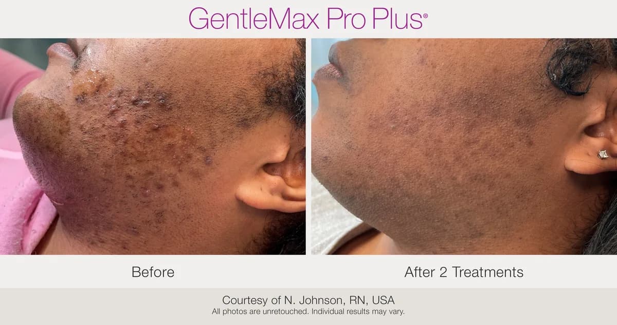 Candela GentleMax Pro Plus® : résultat avant et après, cas 14