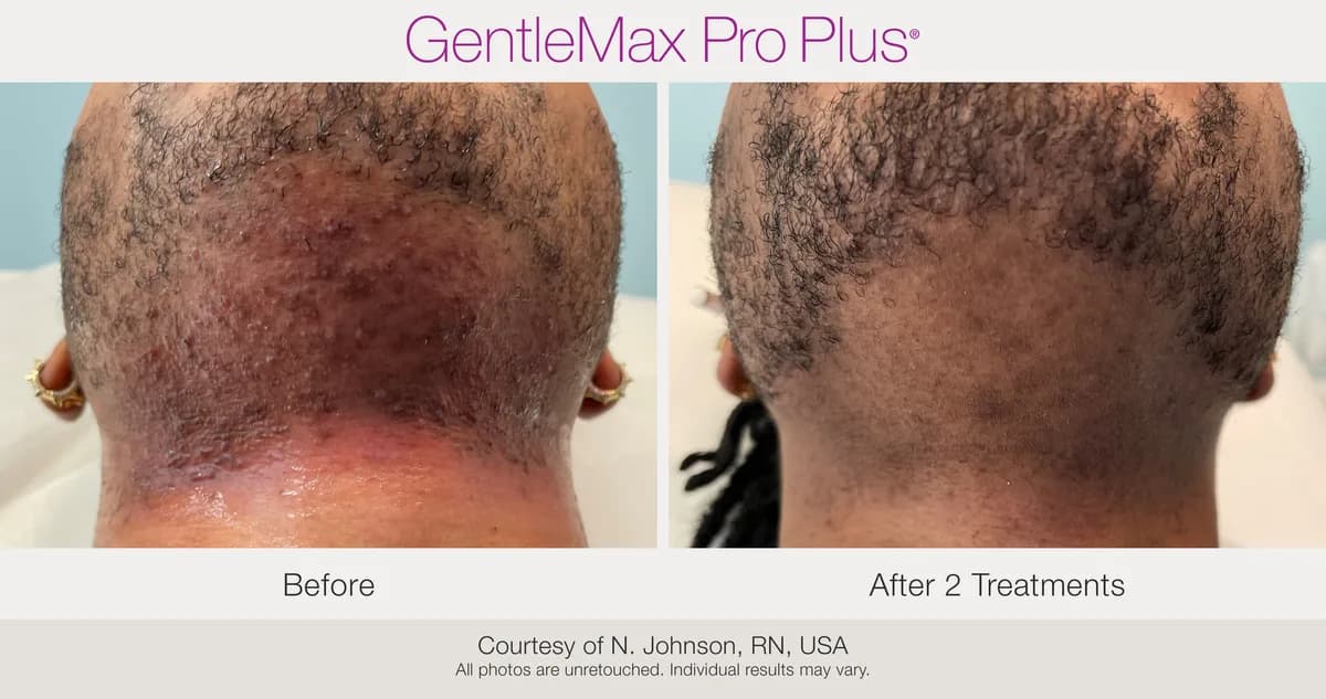 Candela GentleMax Pro Plus® : résultat avant et après, cas 15