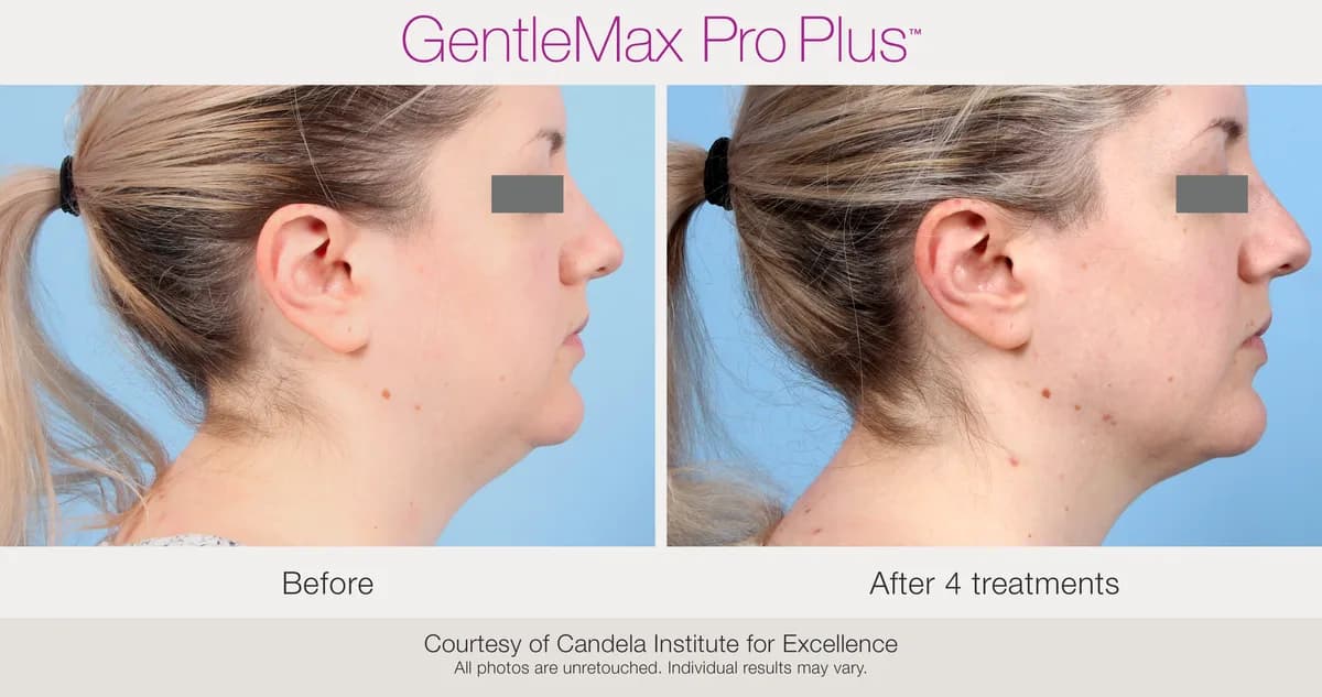 Candela GentleMax Pro Plus® : résultat avant et après, cas 16
