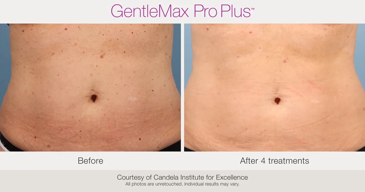 Candela GentleMax Pro Plus® : résultat avant et après, cas 17