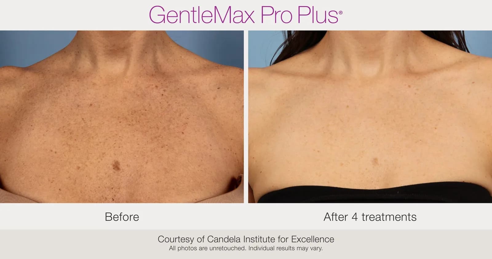 Candela GentleMax Pro Plus® : résultat avant et après, cas 18