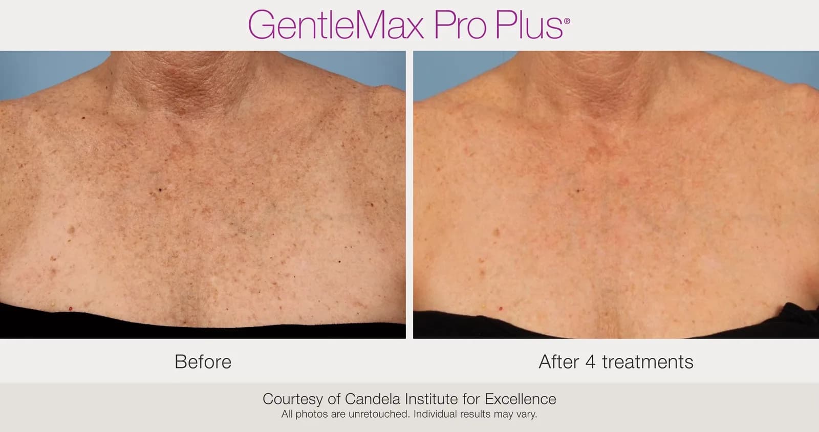 Candela GentleMax Pro Plus® : résultat avant et après, cas 19