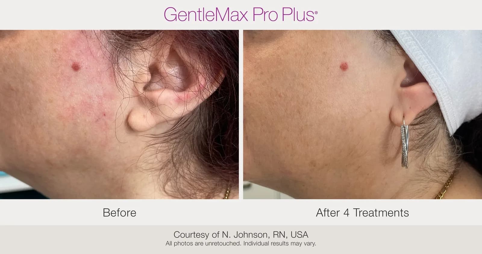 Candela GentleMax Pro Plus® : résultat avant et après, cas 20