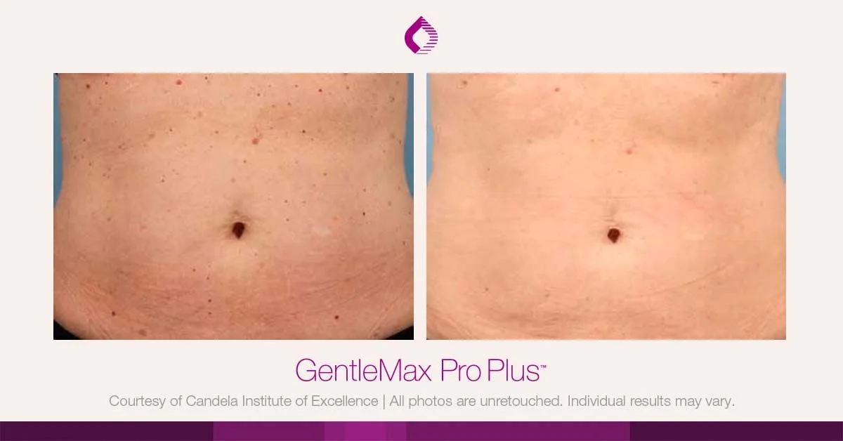 Candela GentleMax Pro Plus® : résultat avant et après, cas 21