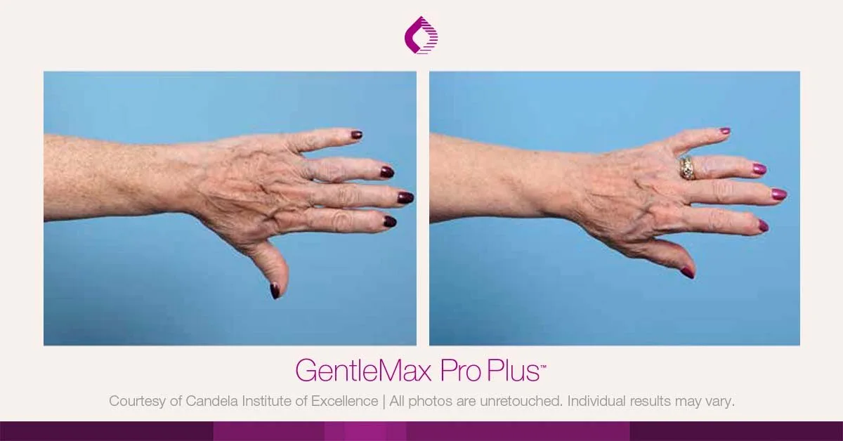 Candela GentleMax Pro Plus® : résultat avant et après, cas 22