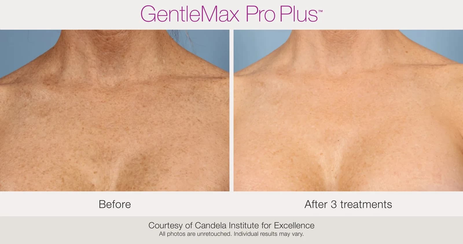 Candela GentleMax Pro Plus® : résultat avant et après, cas 23