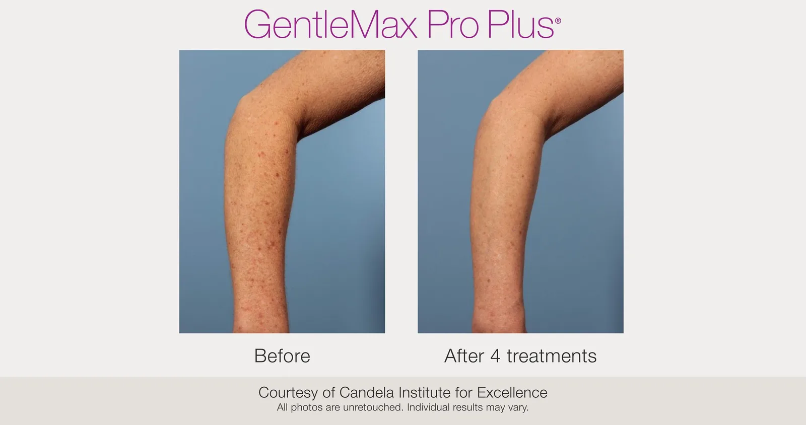 Candela GentleMax Pro Plus® : résultat avant et après, cas 24