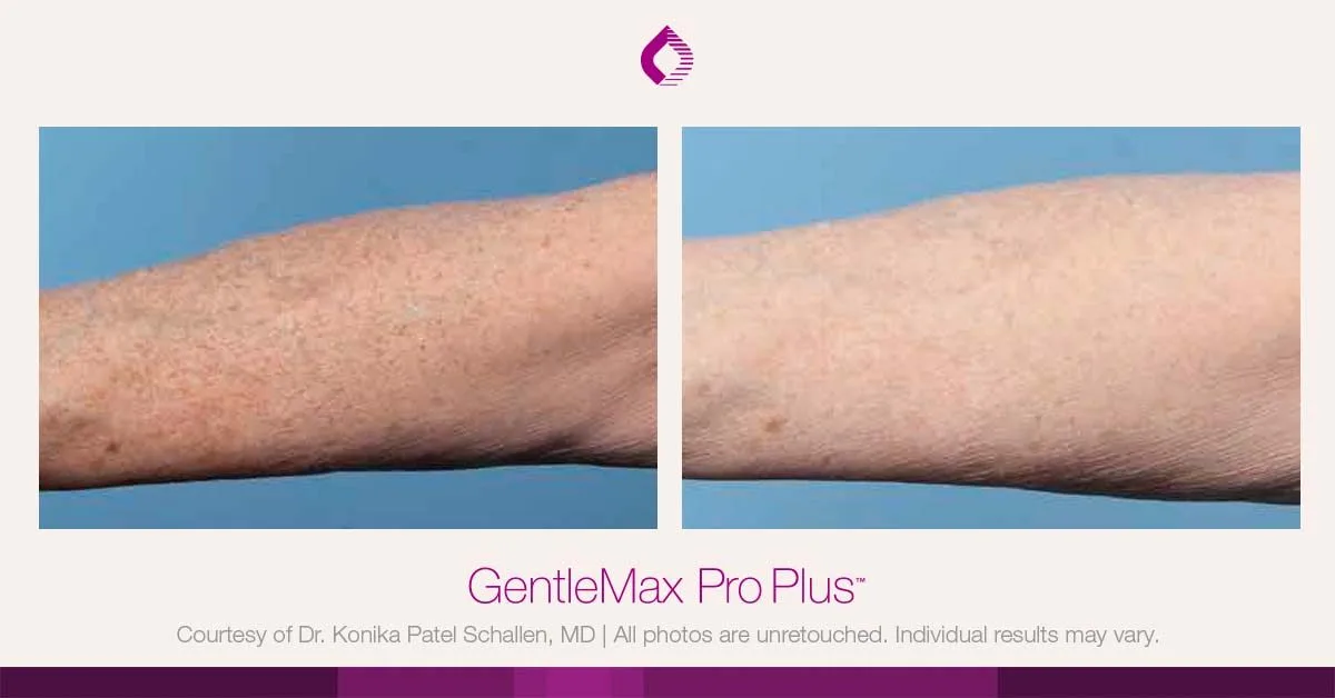Candela GentleMax Pro Plus® : résultat avant et après, cas 25