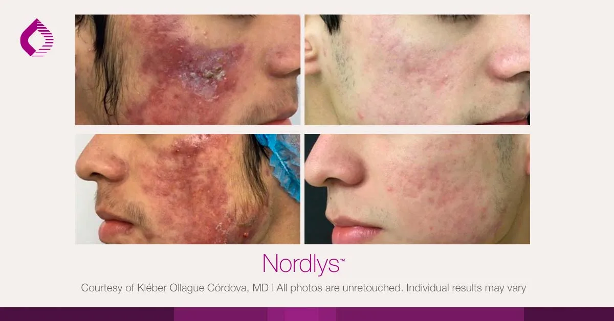 Candela Nordlys® : résultat avant et après, cas 20