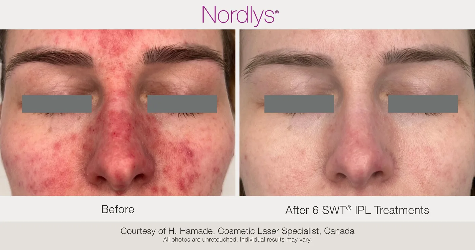 Candela Nordlys® : résultat avant et après, cas 26