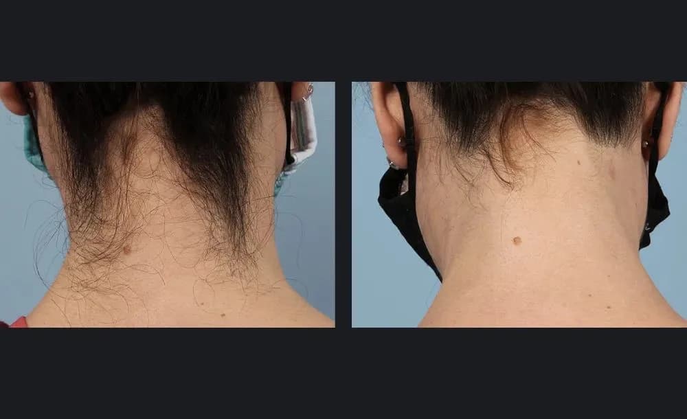 epilation-laser : résultat avant et après, cas 1
