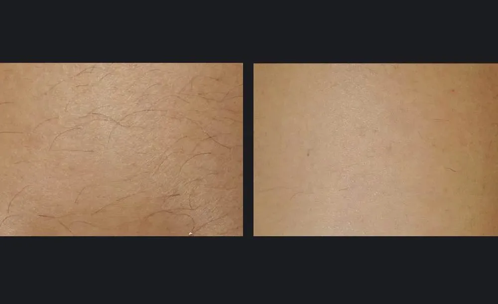 epilation-laser : résultat avant et après, cas 2