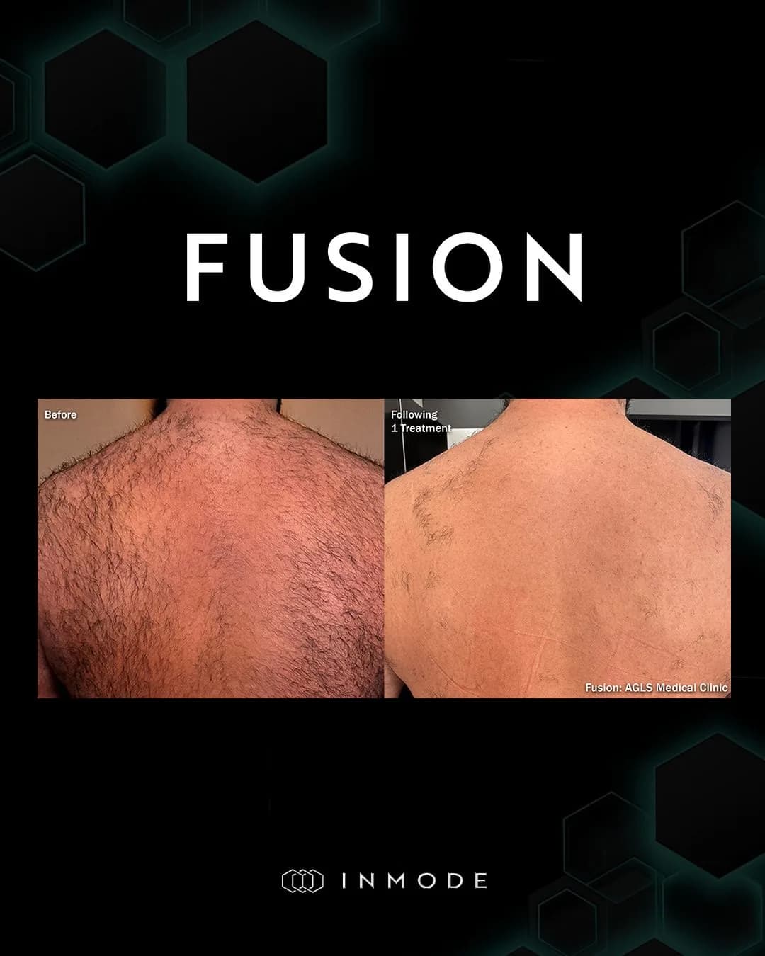 epilation-laser : résultat avant et après, cas 3