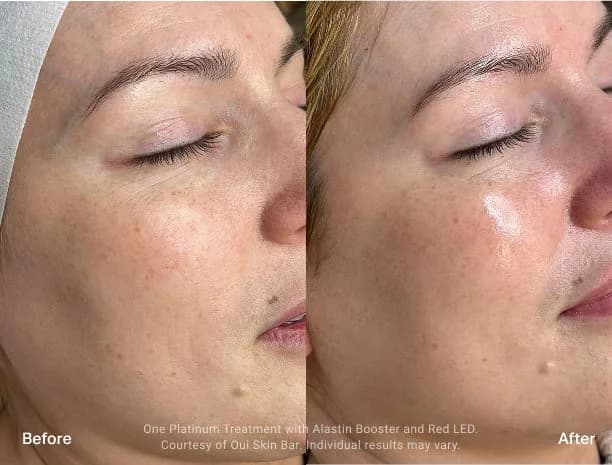 HydraFacial : résultat avant et après, cas 1
