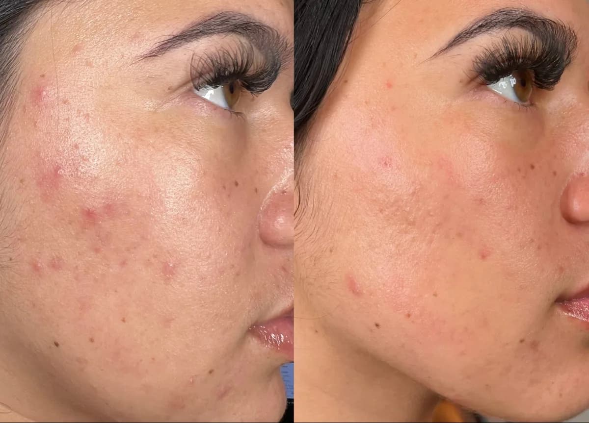 HydraFacial : résultat avant et après, cas 2