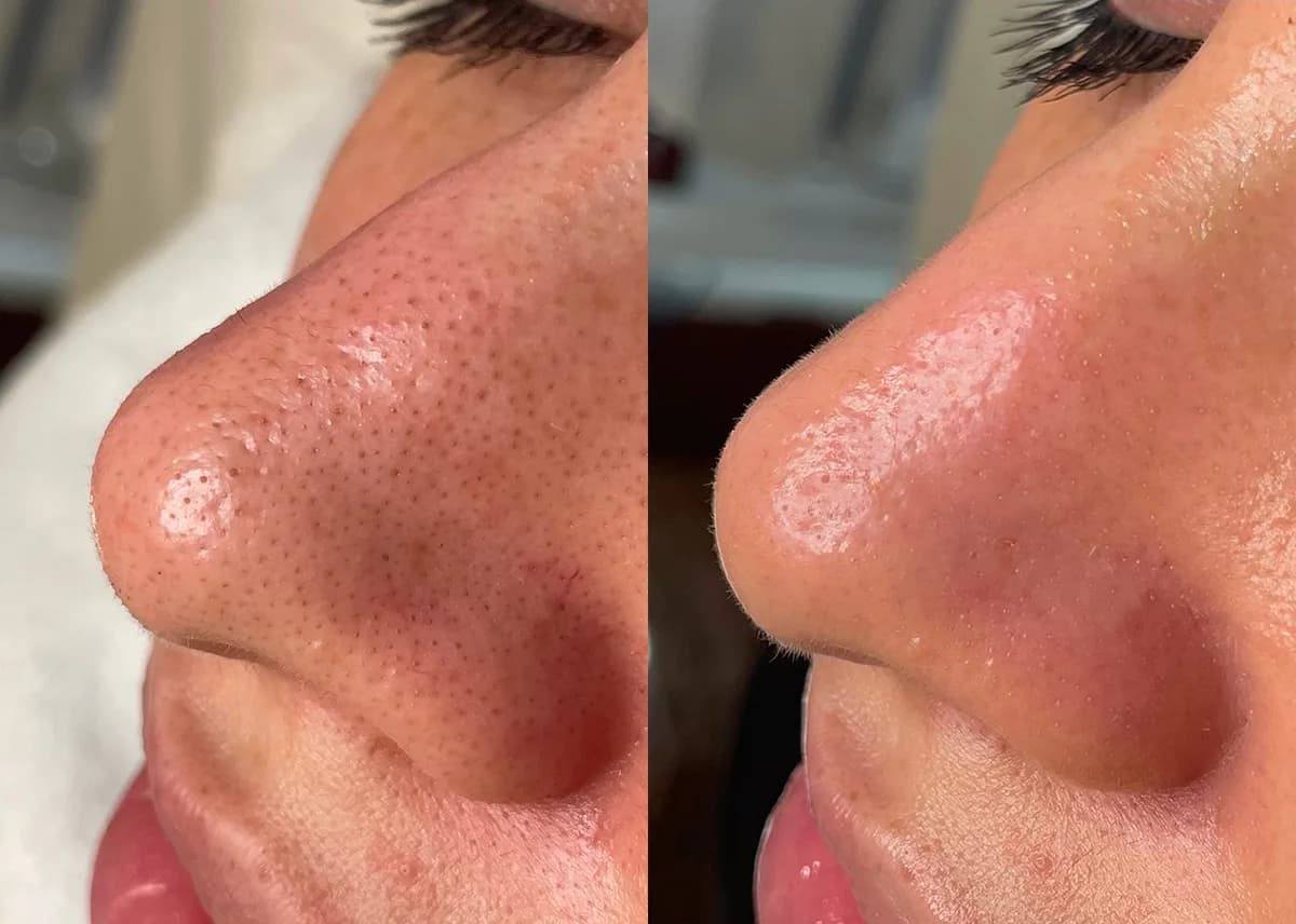 HydraFacial : résultat avant et après, cas 3