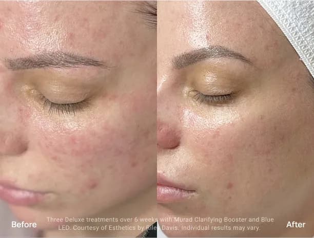 HydraFacial : résultat avant et après, cas 4