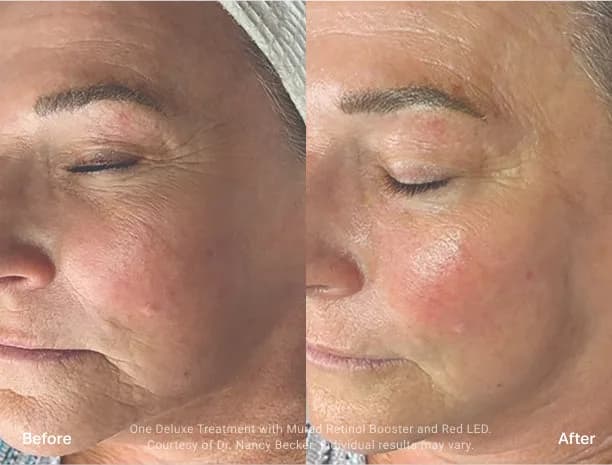 HydraFacial : résultat avant et après, cas 5