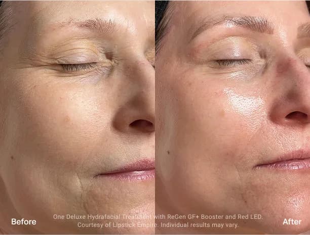 HydraFacial : résultat avant et après, cas 6