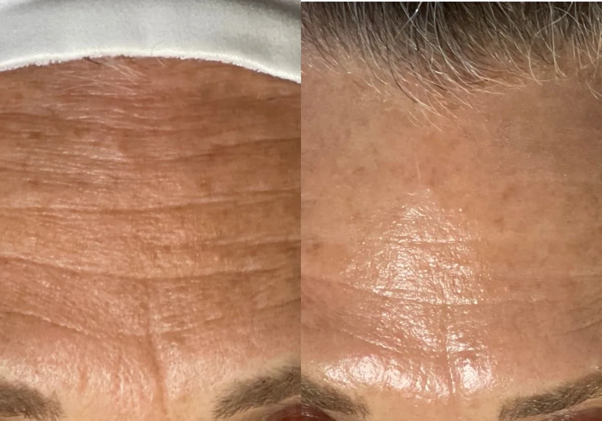 HydraFacial : résultat avant et après, cas 7