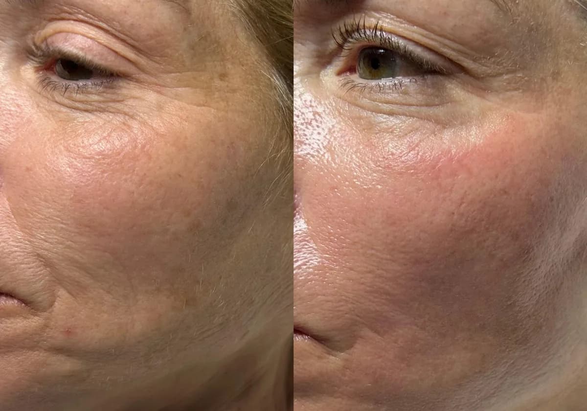 HydraFacial : résultat avant et après, cas 8