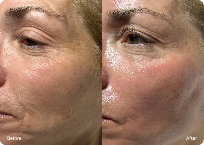 HydraFacial : résultat avant et après, cas 9