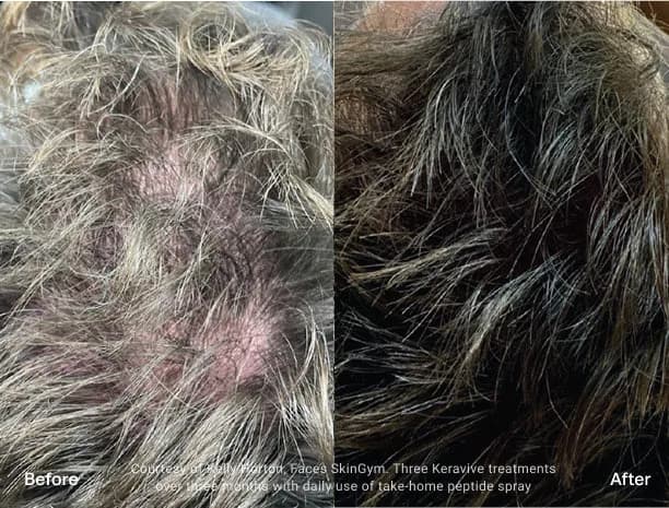 HydraFacial Keravive : résultat avant et après, cas 1