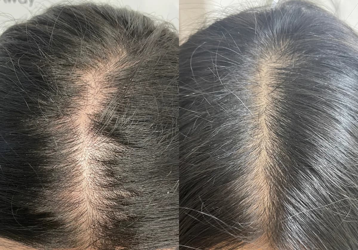 HydraFacial Keravive : résultat avant et après, cas 2
