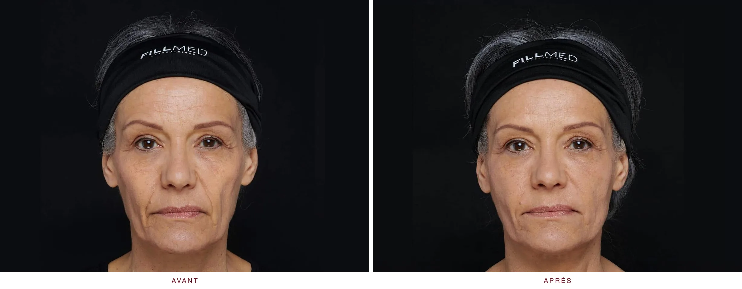 Injectables en médecine esthétique : résultat avant et après, cas 5