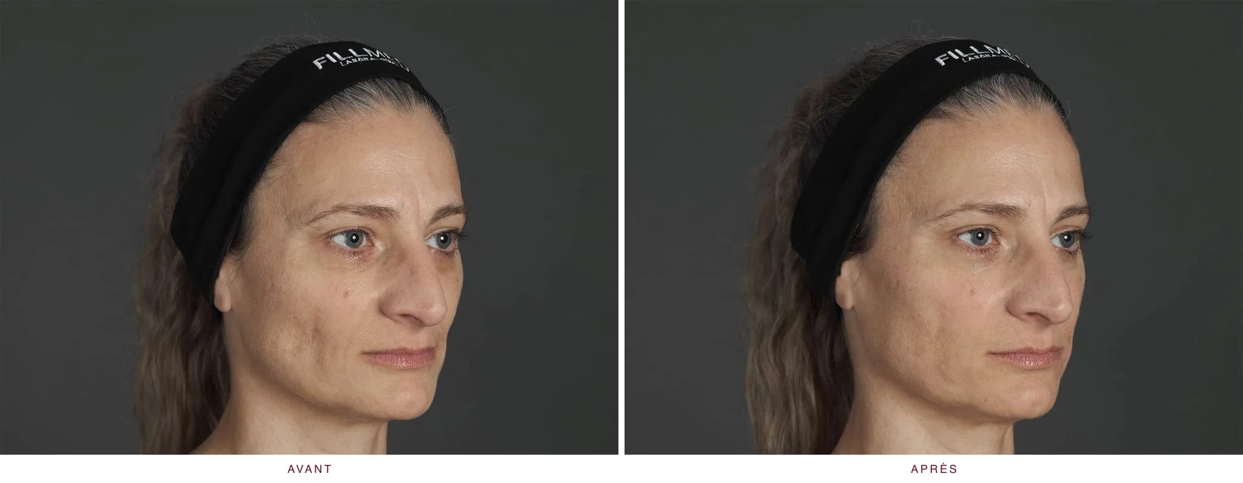 Injectables en médecine esthétique : résultat avant et après, cas 3