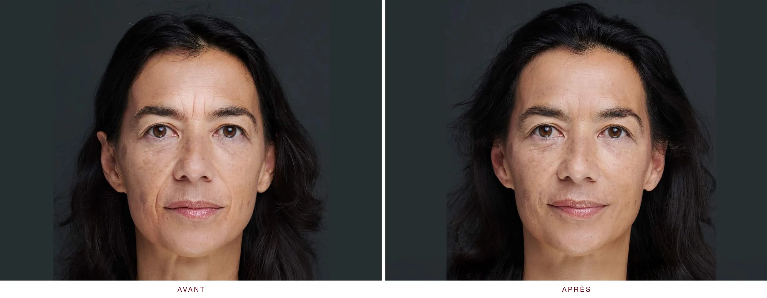 Injectables en médecine esthétique : résultat avant et après, cas 7