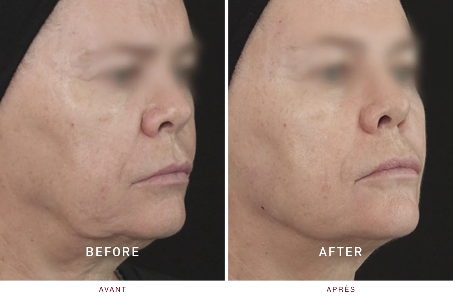 Injectables en médecine esthétique : résultat avant et après, cas 1
