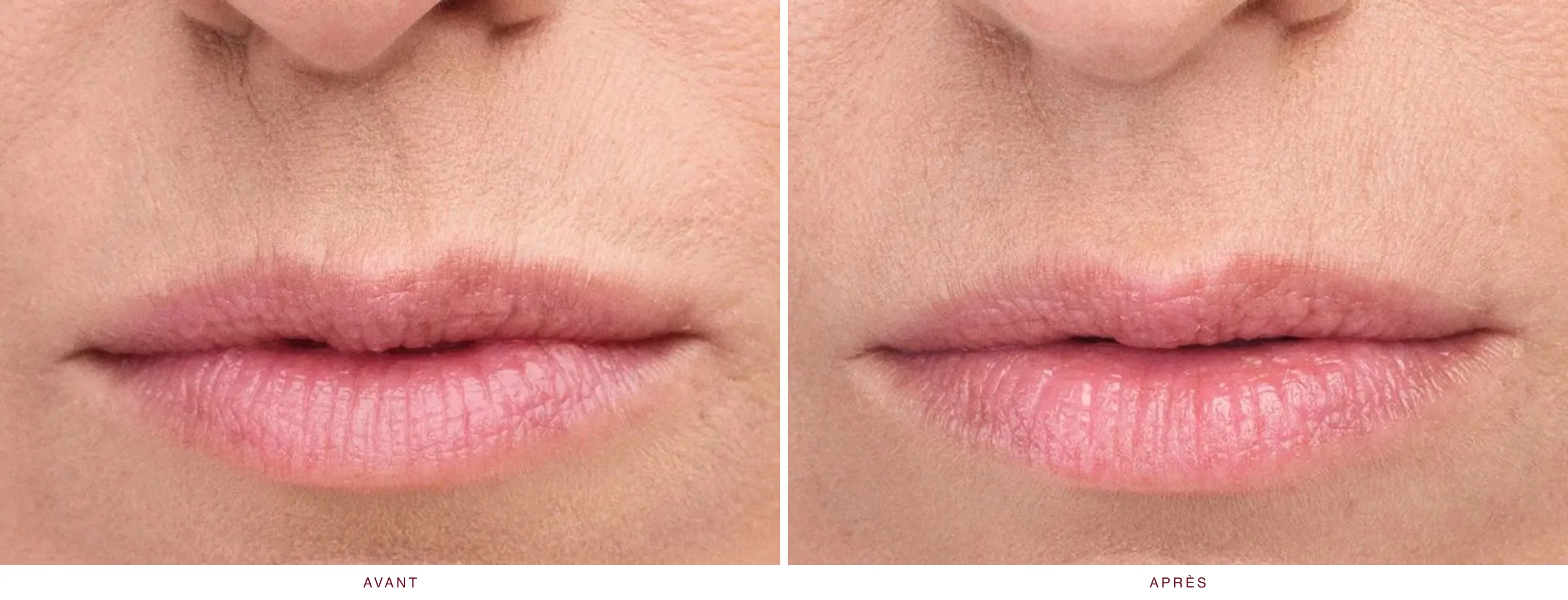 Injectables en médecine esthétique : résultat avant et après, cas 8