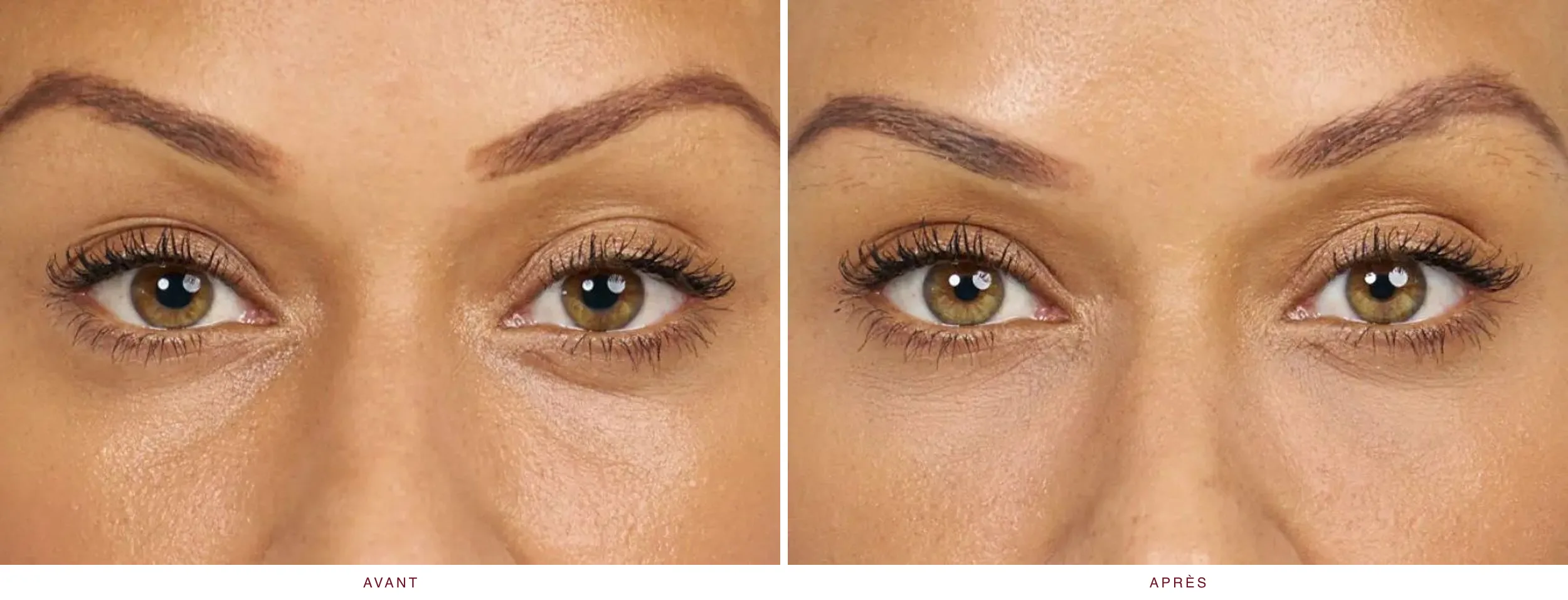 Injectables en médecine esthétique : résultat avant et après, cas 4