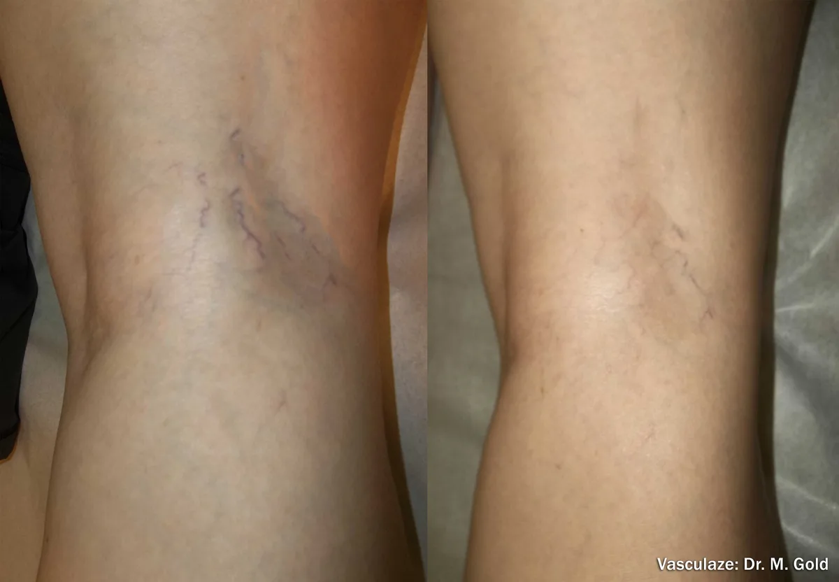 InMode Vasculaze® Max laser Nd:YAG long pulse : résultat avant et après, cas 2