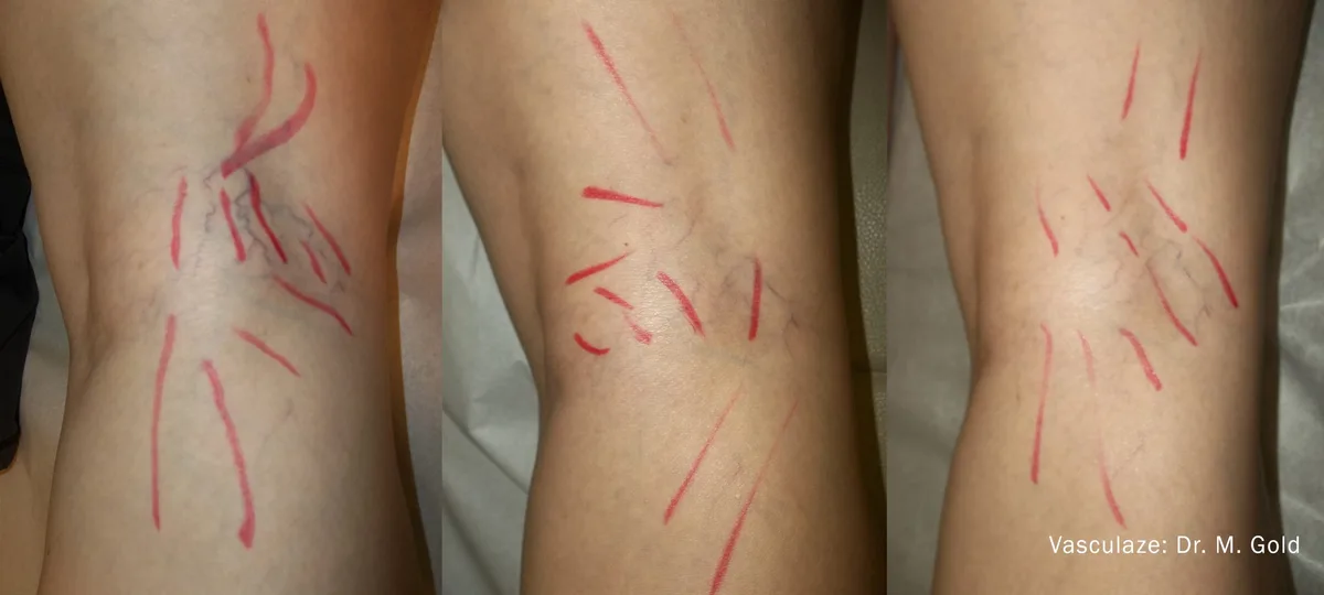 InMode Vasculaze® Max laser Nd:YAG long pulse : résultat avant et après, cas 3