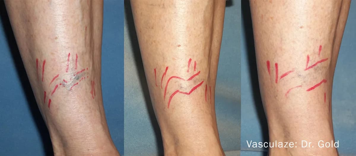 InMode Vasculaze® Max laser Nd:YAG long pulse : résultat avant et après, cas 4