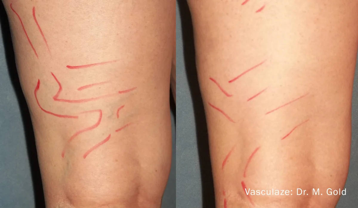 InMode Vasculaze® Max laser Nd:YAG long pulse : résultat avant et après, cas 5
