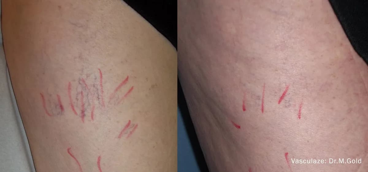 InMode Vasculaze® Max laser Nd:YAG long pulse : résultat avant et après, cas 6