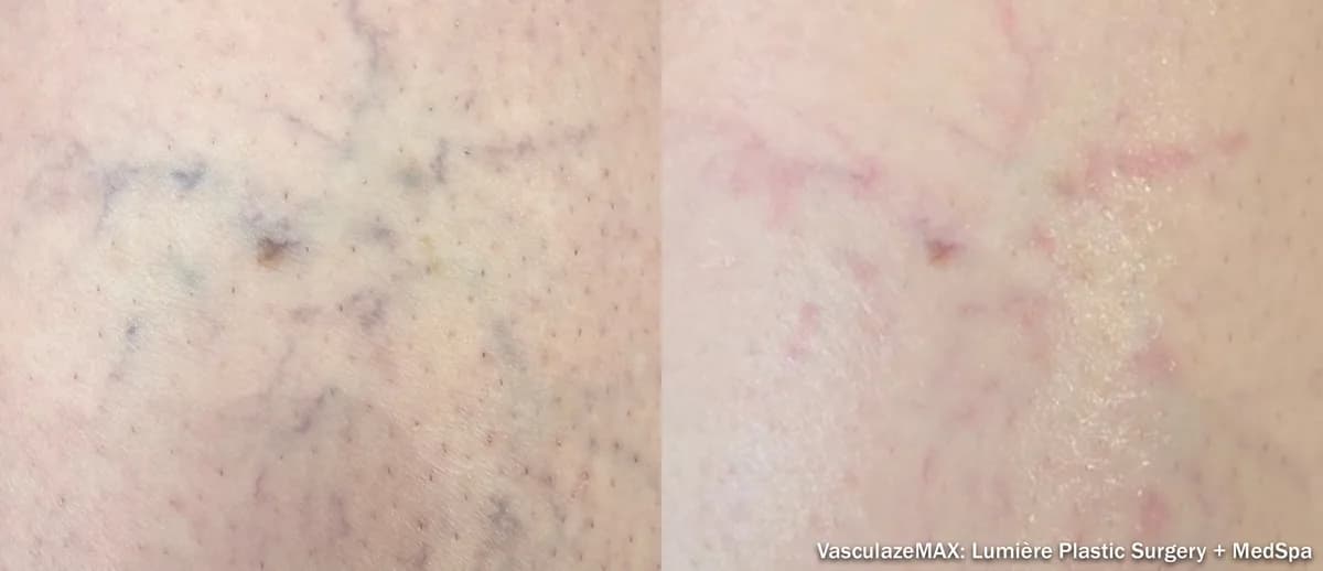 InMode Vasculaze® Max laser Nd:YAG long pulse : résultat avant et après, cas 7
